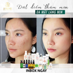 trị mụn anvee